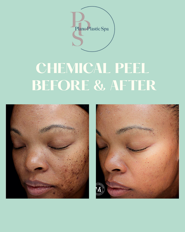 Chemical peel before and after post