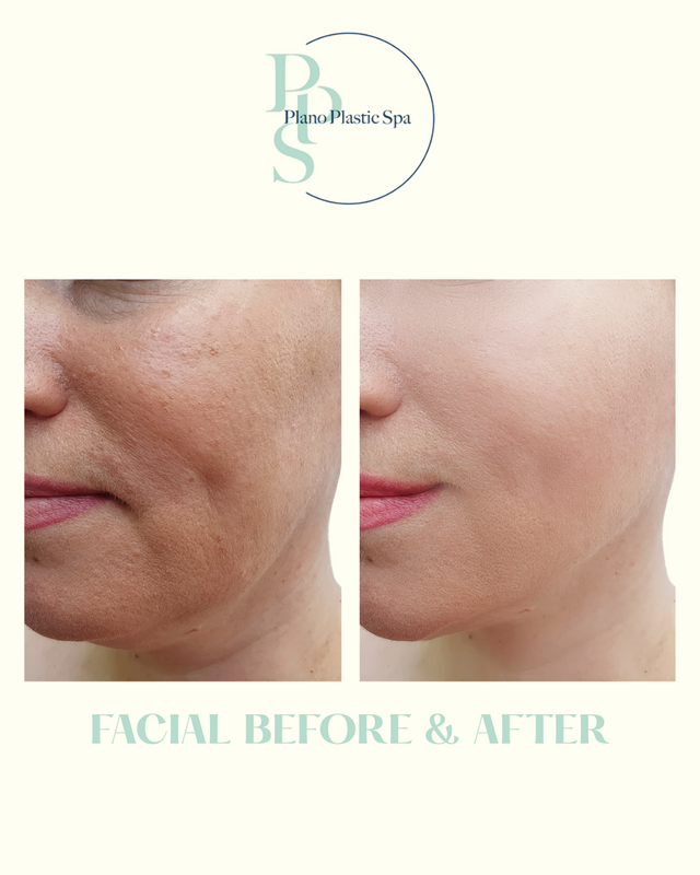 Before and after skin result